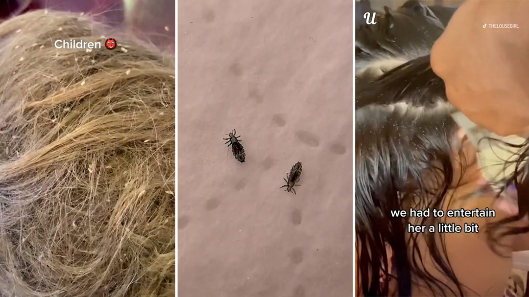 Lice removal experts share kids' horrifying infestations